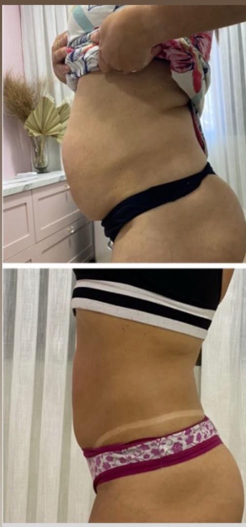 Comparação de antes e depois de aluna, de lado, com o volume da barriga reduzido